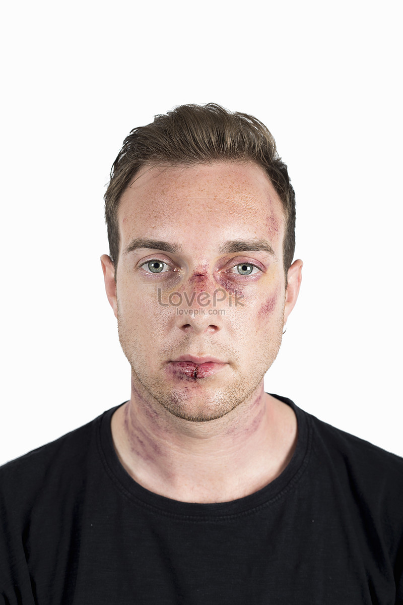 Facial injuries photos