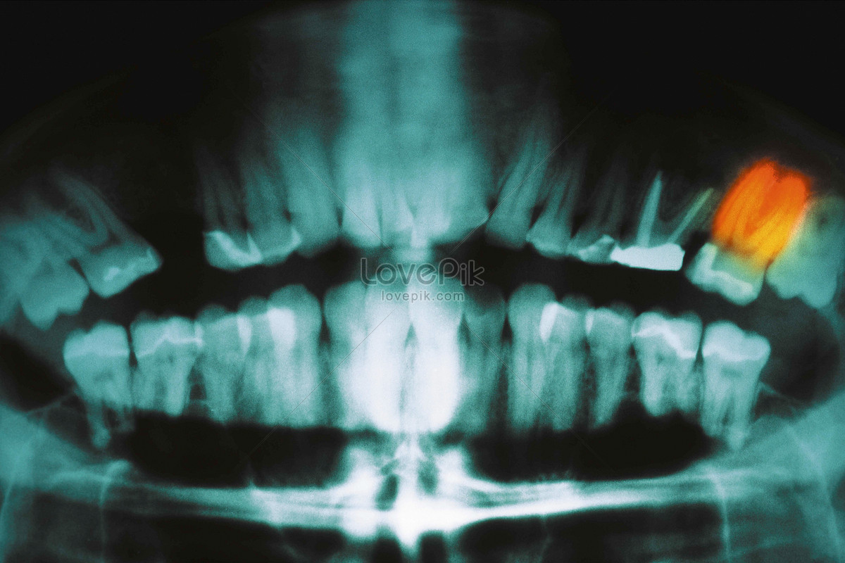 Dental X-ray Picture And HD Photos | Free Download On Lovepik