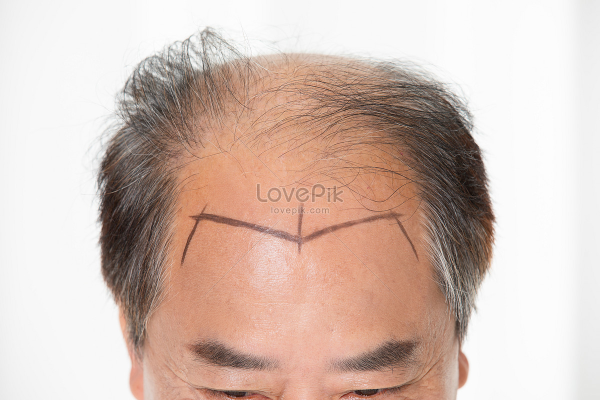 8 điều cần biết về cấy ghép tóc trước khi thực hiện | ELLE Man Việt Nam
