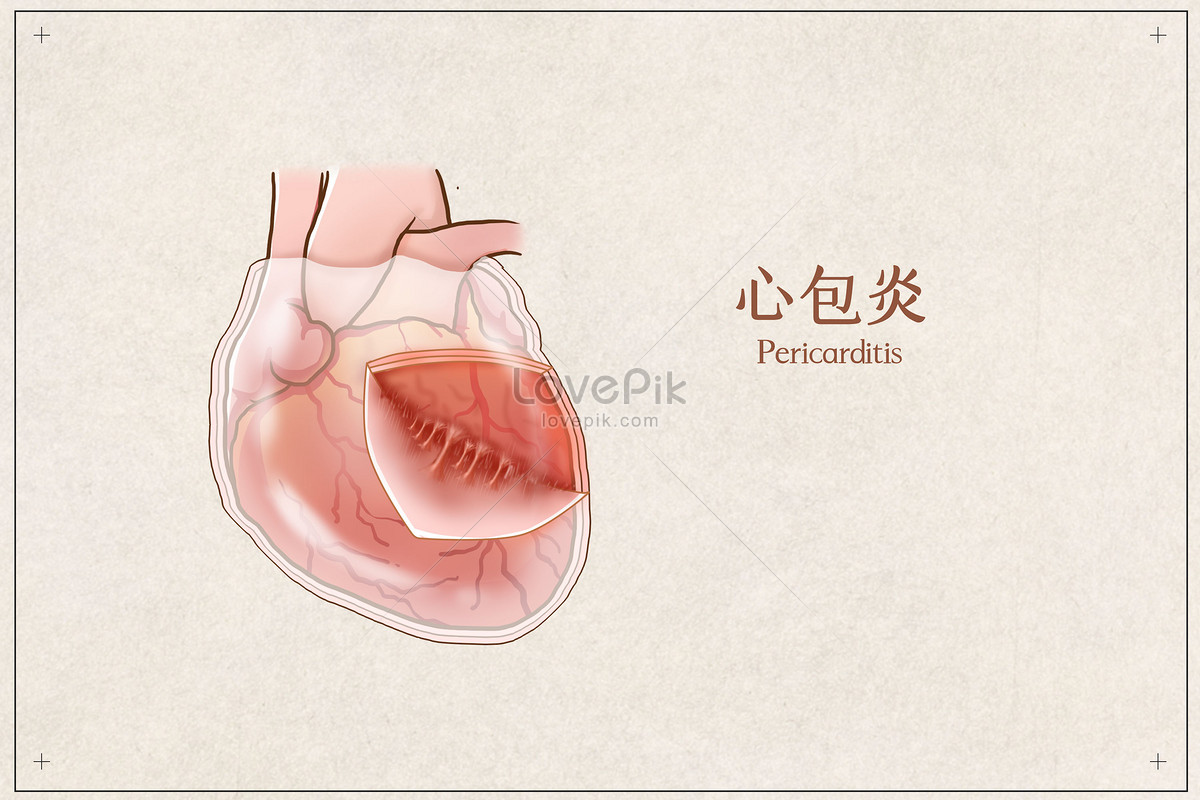 Pericarditis Medical Illustration Illustration Image Picture Free